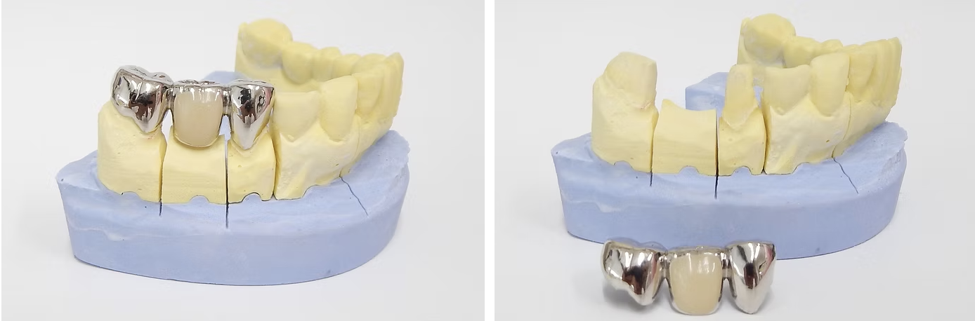 ブリッジ装着前後