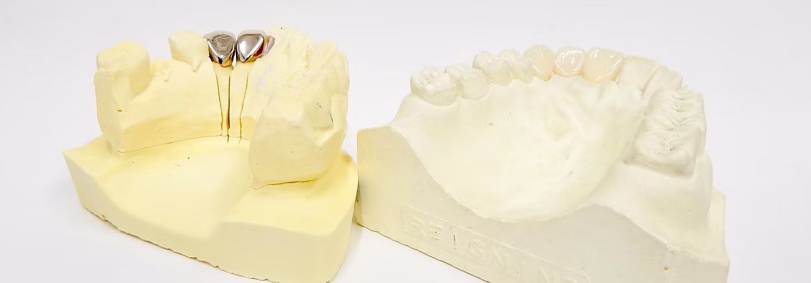 クラウン（被せ物）装着