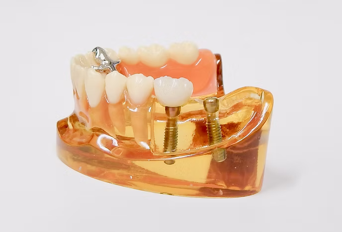 インプラント治療