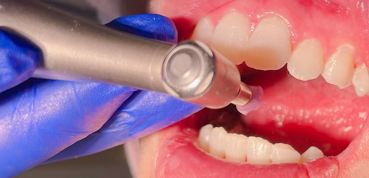 ホワイトニング施術