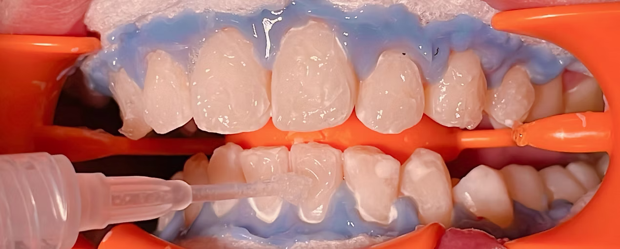 ホワイトニング施術